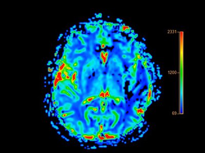 Jak zatrzymać rozprzestrzenianie się Alzheimera? Nowe odkrycie daje nadzieję