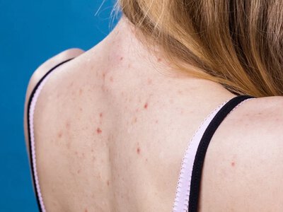 Wypryski na plecach latem do zmora. Dermatolog radzi, jak się ich pozbyć